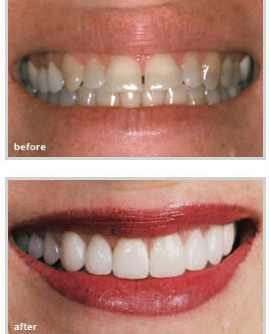 Teeth before and after treatment