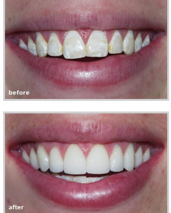 Teeth before and after treatment