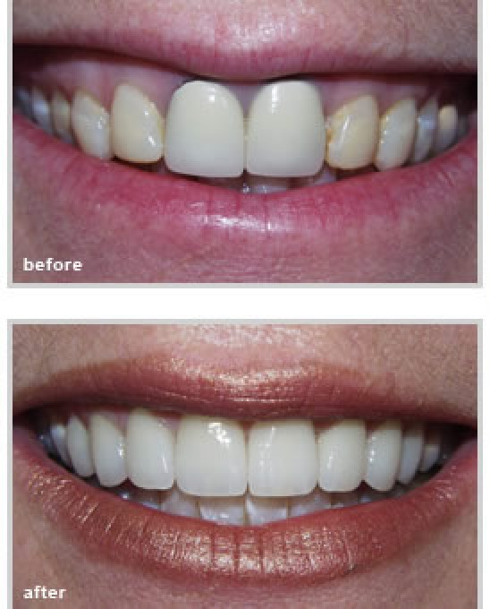 Teeth before and after treatment