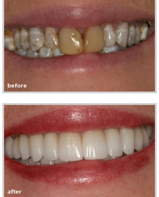 Teeth before and after treatment